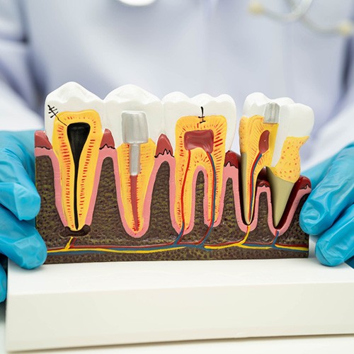 A CGI image of a tooth getting pulp therapy