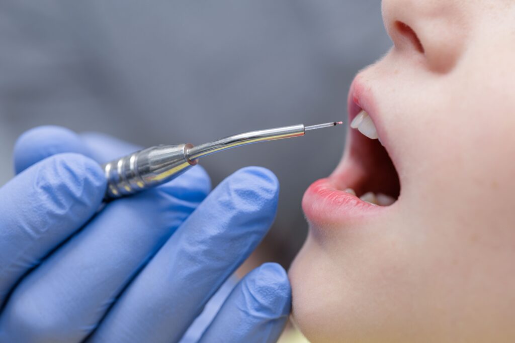 Dentist holding laser up to pediatric patient's mouth